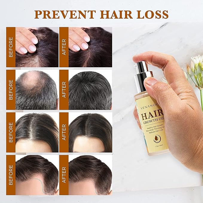 Hair Growth Oil with Rosemary & Biotin: Natural Hair Regrowth Serum for Women & Men – Anti Hair Loss & Thinning Treatment – Promotes Thicker, Fuller, Stronger, Healthier Hair – All Hair Types 2 packs