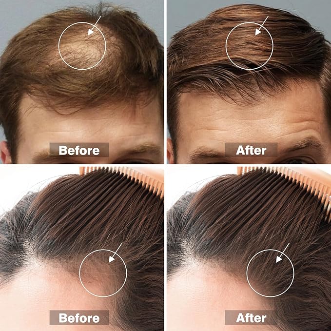 5% Minoxidil Hair Growth Serum Kit for Men and Women, Hair Growth Biotin Serum Oil for Hair Beard Regrowth Treatment Hair Loss Solution