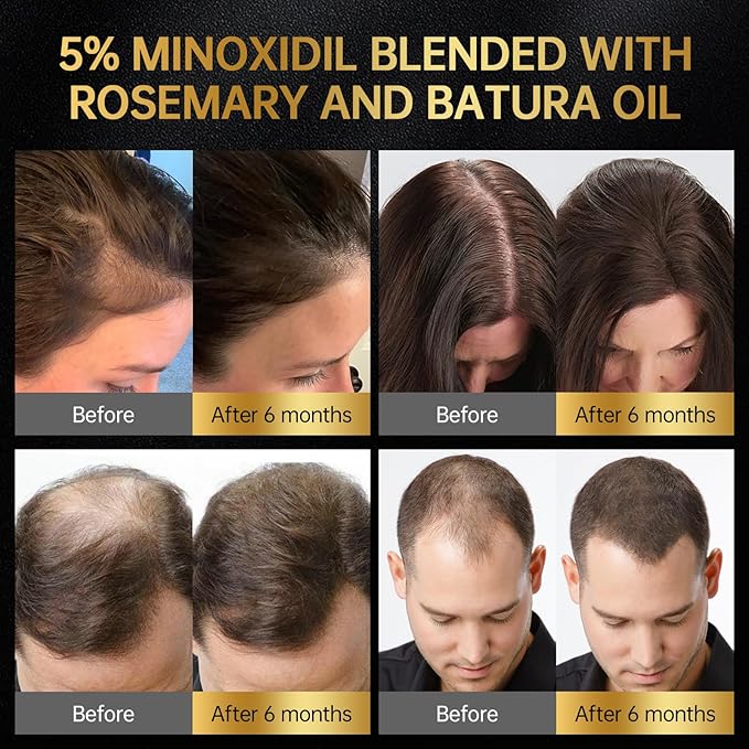 Minoxidil for Men & Women, With Biotin, Batana Oil, Rosemary Essential Oil, Effective Hair Loss Solution, Hair Loss Treatment for Hair Regrowth, Non-Greasy 5% Minoxidil - 60ml(Serum + Massager Set)