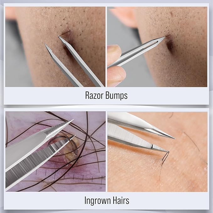 DUROX 3-Piece Tweezer Set — 1.Pointed Ingrown Hair Tweezers, 2.Fine-Tip Splinter Tweezers, 3.Safety Round Tip for Facial & Chin Hair Removal. Made of stainless steel. Protective pouch for safe storage