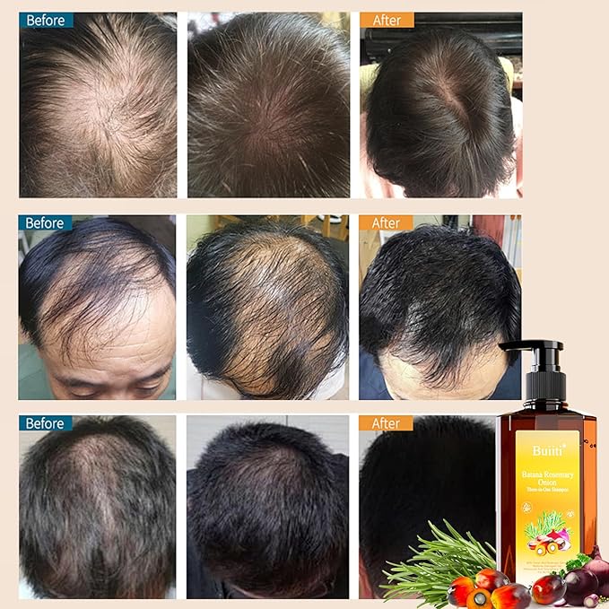 Batana Oil Shampoo for Hair Growth – Infused with Rosemary & Onion, Anti Hair Loss & Thickening Treatment for Women & Men, Promotes Regrowth, Sulfate Free Natural Formula, 10.14 fl oz