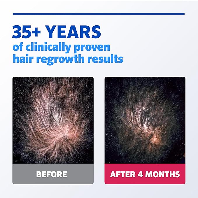 Men's Rogaine Extra Strength 5% Minoxidil Topical Solution for Hair Loss & Regrowth, Topical Treatment for Men, Unscented Minoxidil Follicle Booster Liquid, 1-Month Supply, 2 fl. oz