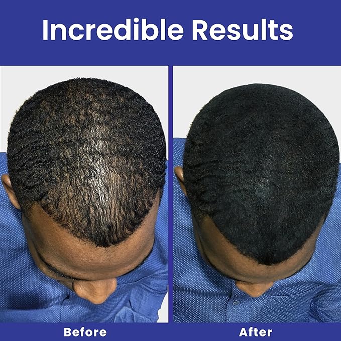 INFINITY Hair Fibers Dark Brown for Thinning Hair for Women & Men - 100% Undetectable Hair Building Fiber Powder - Conceal Hair Loss in 15 Seconds, 15g