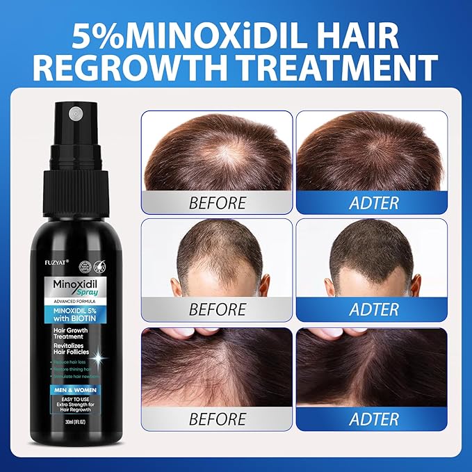 5% Minoxidil for Men Hair Loss Treatment, Minoxidil for Women Hair Growth Spray, For Men & Women, Supports Thinning Hair, With Biotin, Easy Daily Application (60ml)