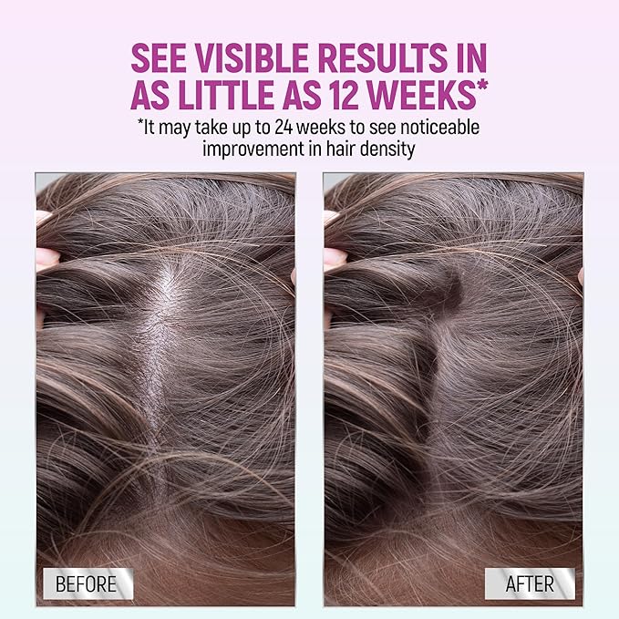 Minoxidil for Women, 2.11 Oz (2 Months Supply) Clinically Proven to Regrow Hair, Topical Aerosol Foam 5%, Hair Thinning Treatment